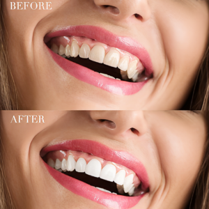 Blanqueador dental Carbón activado TEETH WHITENING 60ml