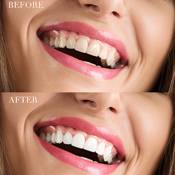 H028cd9ea0a4442d2aaf0dc32fafc57eaV.png Blanqueador dental Carbón activado TEETH WHITENING 60ml